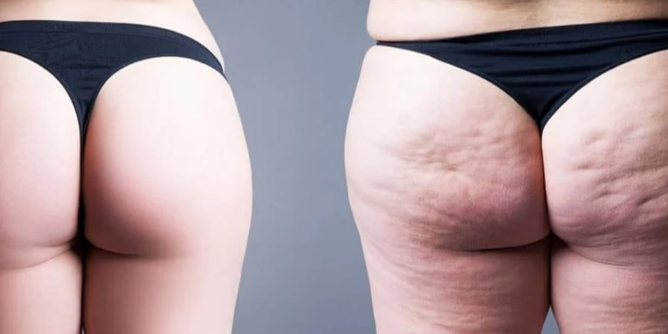 Rappresentazione visiva dell'articolo: Lipedema e linfedema: l'importanza della dieta nella gestione dei due disturbi