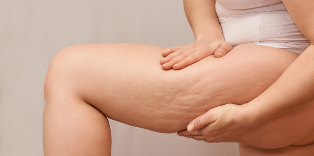 Rappresentazione visiva dell'articolo: Come si riconosce il lipedema alle gambe?