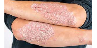 Rappresentazione visiva dell'articolo: Psoriasi e dieta